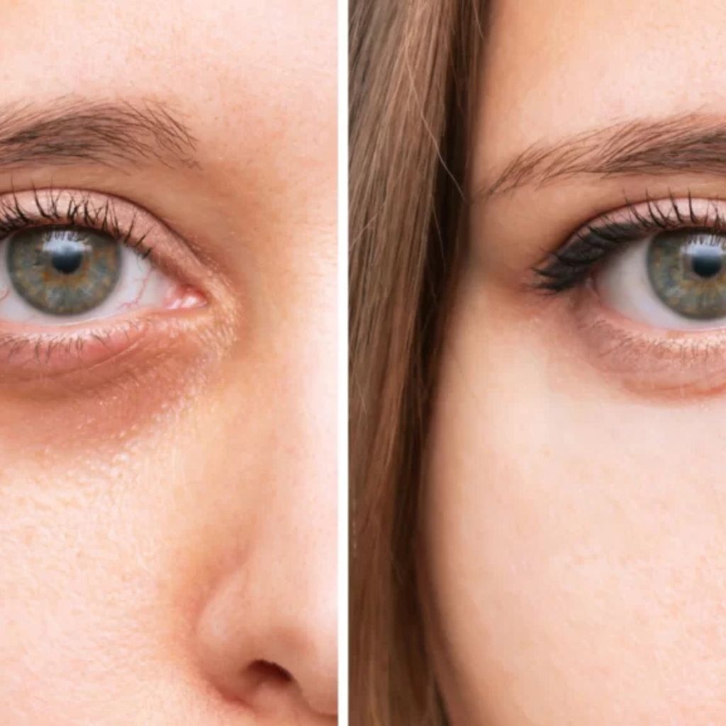 Biostimuliacija JALUPRO rūgščių injekcijomis YOUNG EYE
