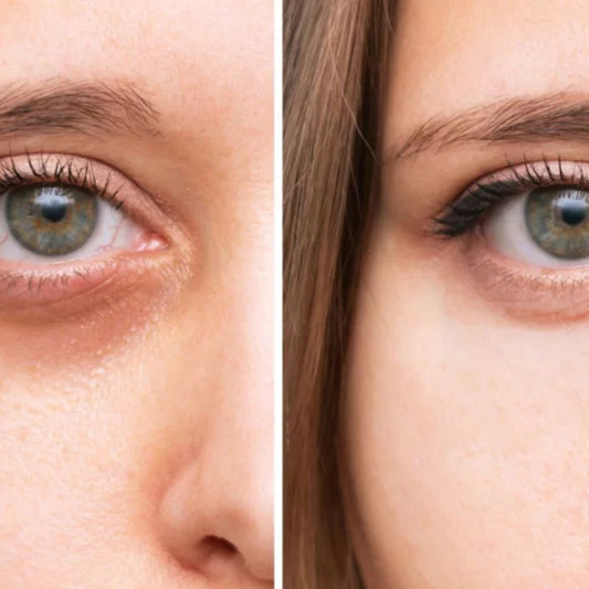Biostimuliacija JALUPRO rūgščių injekcijomis YOUNG EYE